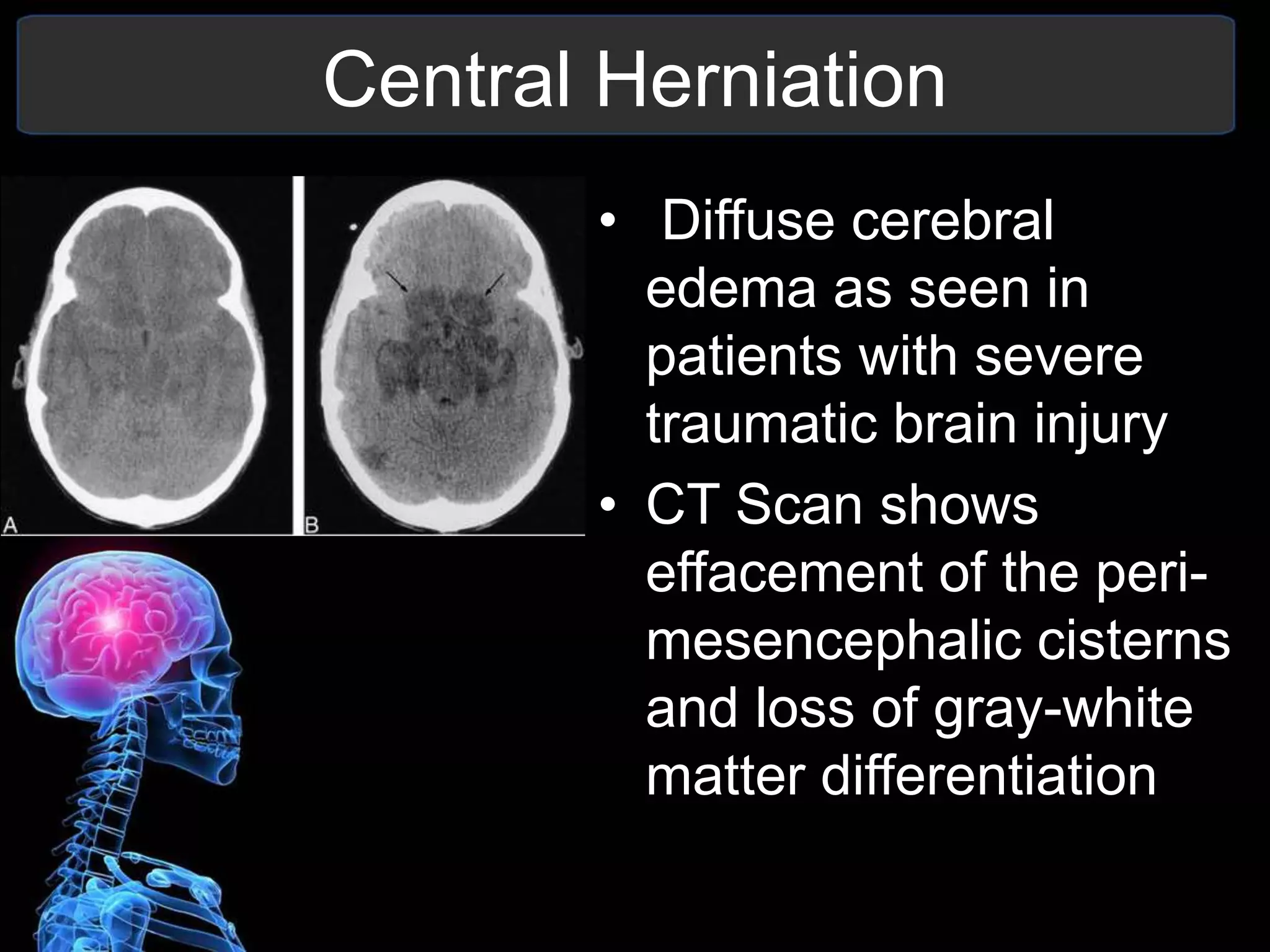 Herniation Syndromes | PPTX