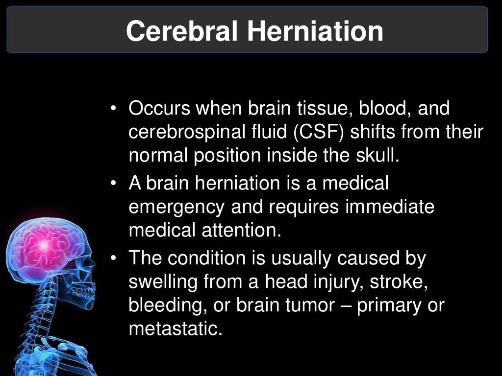 Herniation Syndromes