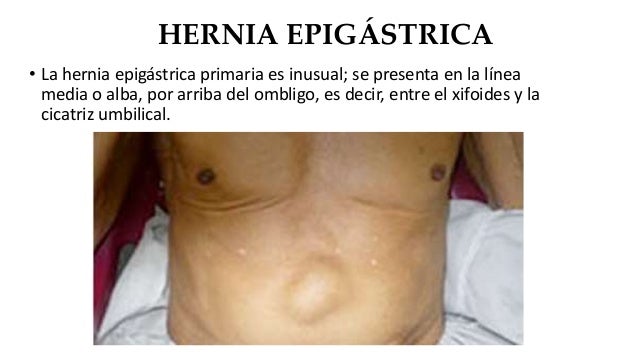 Hernia Umbilical Y Epigastrica