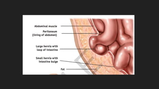 Hernia ventral post incisional | PPTX