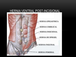 HERNIA VENTRAL POST-INCISIONAL
 