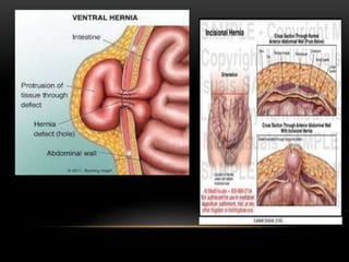 Hernia ventral post incisional | PPTX