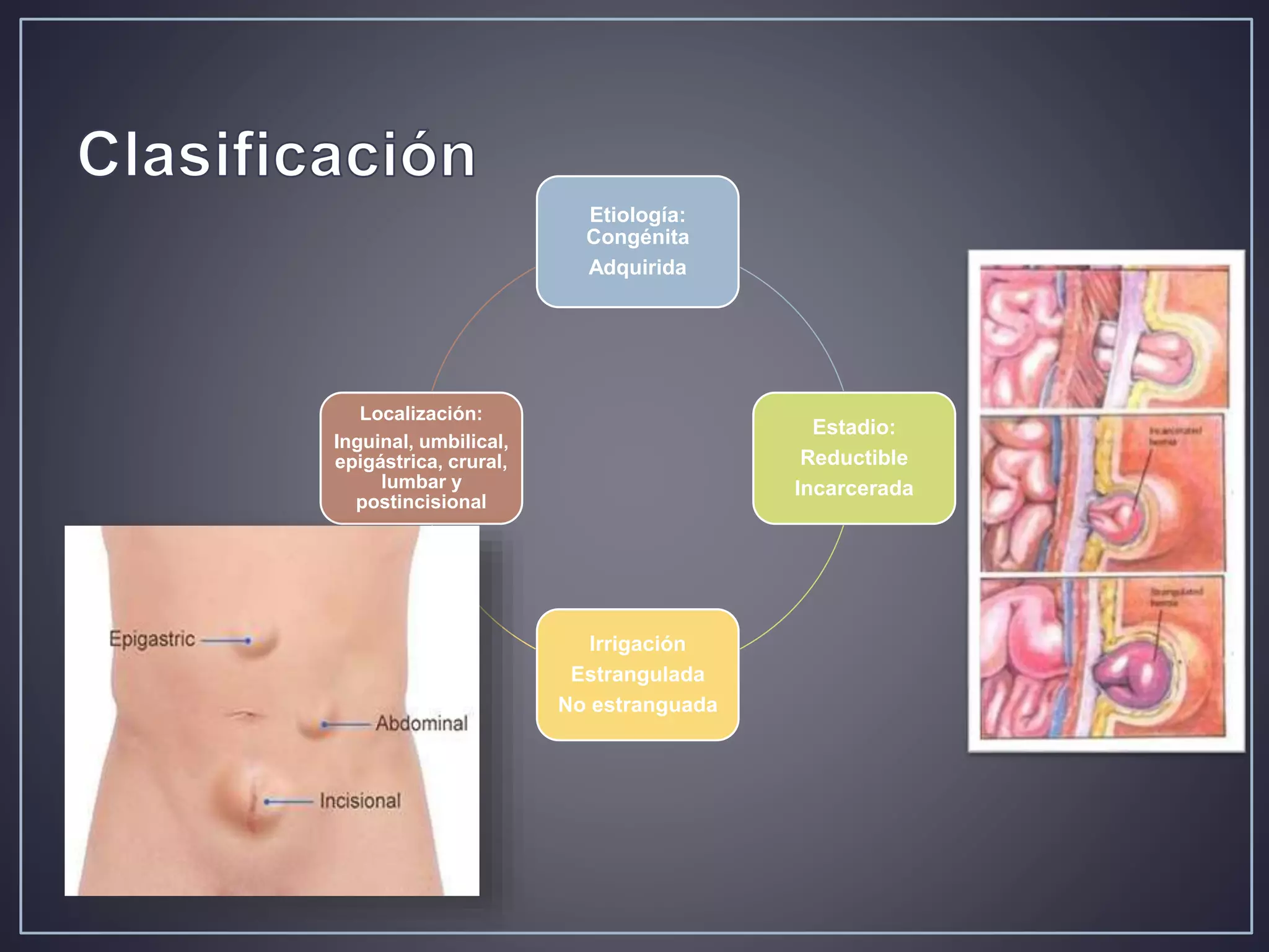 Hernia ventral post incisional | PPT