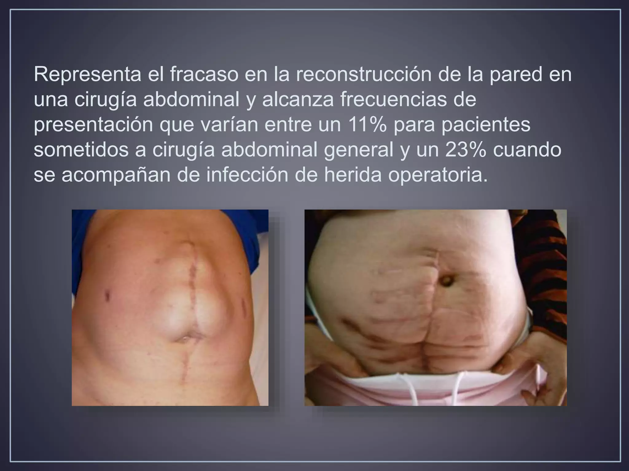 Hernia ventral post incisional | PPTX | Surgery | Medical Health