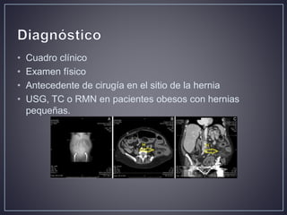 Hernia ventral post incisional | PPTX