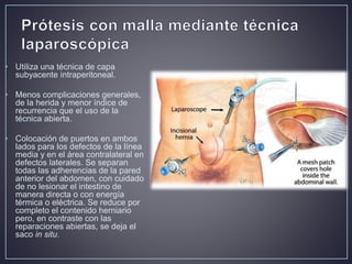 Hernia ventral post incisional | PPTX