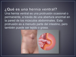 Hernia ventral post incisional | PPTX