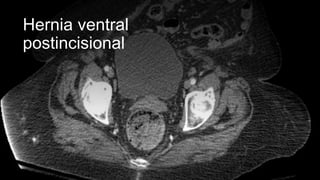 Hernia ventral
postincisional
 