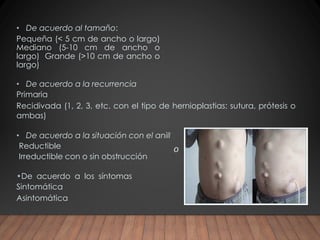 Hernia ventral post incisional Ricardo Young pdf | PDF