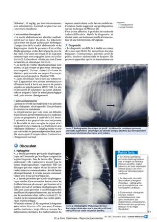 Points forts
! Les hernies péritonéo-
péricardo-diaphragmatiques
sont à l’origine de tableaux
cliniques variables, depuis
l’absence de toute expression
clinique jusqu’à une mort
subite par décompensation
cardiaque.
! Le diagnostic nécessite
des examens d’imagerie
thoracique : radiographie,
parfois complétée par une
échographie cardiaque.
! L’intervention chirurgicale
n’est pas réalisée
systématiquement, mais
après l’évaluation des
malformations concomitantes,
de l’intensité des symptômes
cliniques et du risque
d’évolution.
61/ N° 240 / Novembre 2003 / Le Point Vétérinaire
(Rilexine®
, 15 mg/kg, par voie intraveineuse)
sont administrées. L’animal est placé sur une
couverture chauffante.
! Intervention chirurgicale
• La cavité abdominale est abordée médiale-
ment par la ligne blanche. Le ligament
falciforme est incisé au bistouri électrique.
L’inspection de la cavité abdominale et du
diaphragme révèle la présence d’un orifice
diaphragmatique ventro-latéral gauche, proche
des côtes. Une anse intestinale et de la graisse
mésentérique sont engagées dans cet orifice
(PHOTO 3). La hernie est réduite par taxis. L’anse
est noirâtre et nécrotique (PHOTO 4).
• Les bords de l’orifice diaphragmatique sont
atones, ce qui évoque un processus chronique
ou congestif. Ils sont avivés à la lame de
bistouri, puis suturés au moyen d’un surjet
simple au polypropylène (Prolène®
2/0).
• L’anse nécrotique est excisée par entérecto-
mie. L’apposition des abouts intestinaux est
effectuée bord à bord au moyen de points
simples au polydioxanone (PDS®
3/0). Le site
est recouvert de mésentère. La cavité abdomi-
nale est irriguée à l’aide de soluté physiologique
tiédi, puis suturée classiquement.
! Soins postopératoires
L’animal se réveille normalement et ne présente
plus ni dyspnée, ni tachycardie. Une perfusion
d’entretien est maintenue.
La réhydratation par voie orale est débutée
douze heures après l’intervention et la réalimen-
tation est progressive à partir de la 24e
heure.
Il est rendu à son propriétaire avec un pronos-
tic favorable et une consigne de repos strict
pendant trois semaines. Le traitement à la
céfalexine (Rilexine®
, 15 mg/kg matin et soir
par voie orale) est poursuivi pendant huit jours.
Six mois après l’intervention, l’animal est
cliniquement normal.
Discussion
1. Pathogénie
• La hernie péritonéo-péricardo-diaphragma-
tique est l’anomalie péricardique congénitale
la plus fréquente. Avec la hernie dite “pleuro-
péritonéale”, elle représente le second type de
hernie diaphragmatique congénitale. Elle s’en
distingue par son origine et par la nature des
cavités mises en communication : lors de hernie
pleuropéritonéale, il n’existe aucune communi-
cation avec le sac péricardique [2].
• La hernie péritonéo-péricardo-diaphragma-
tique résulte d’une mauvaise fusion entre les
feuillets latéraux pleuraux et péritonéaux et la
portion sternale et médiane du diaphragme [1].
Elle peut aussi provenir d’un développement
insuffisant du septum transverse, qui se traduit
par la persistance d’un orifice ventral [2]. Le
résultat est la communication des cavités périto-
néale et péricardique.
• Plusieurs auteurs [3, 6] rapportent la fréquente
association de cette affection avec d’autres
malformations congénitales comme les
déformations sternales, les malformations du
septum ventriculaire ou la hernie ombilicale.
Certaines études suggèrent une prédisposition
raciale du braque de Weimar [4].
Face à cette affection, le praticien est confronté
à deux difficultés : établir le diagnostic, et
choisir entre un traitement médical conserva-
teur et une intervention chirurgicale.
2. Diagnostic
• Le diagnostic est difficile à établir en raison
de la non-spécificité des symptômes les plus
fréquents : vomissements, anorexie, perte de
poids, douleur abdominale et dyspnée. Ils
peuvent apparaître après un traumatisme ou
!!
PHOTO 1. Radiographie thoracique de profil : la silhouette cardiaque présente
une taille augmentée. Des images de densité aérique (flèches) qui correspondent
aux anses intestinales herniées sont visibles.
Cliché:S.Bureau
PHOTO 2. Radiographie thoracique de face :
les images observées sur la vue de profil sont
retrouvées sur cette incidence (flèche).
Cliché:S.Bureau
(1) Médicament
à usage humain.
© Le Point Vétérinaire - Reproduction interdite
 