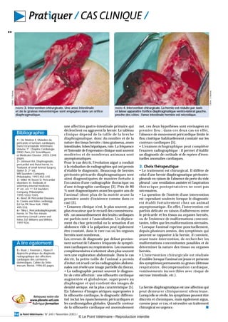 une affection gastro-intestinale primaire qui
déclenchent ou aggravent la hernie. Le tableau
clinique dépend de la taille de la brèche
diaphragmatique, donc du nombre et de la
nature des tissus herniés : tissu graisseux, anses
intestinales, lobes hépatiques, rate. La fréquence
et l’intensité de l’expression clinique sont souvent
modérées et de nombreux animaux sont
asymptomatiques.
Pour le cas décrit, l’évolution aiguë a conduit
à la réalisation de radiographies qui ont permis
d’établir le diagnostic. Beaucoup de hernies
péritonéo-péricardo-diaphragmatiques sont
ainsi diagnostiquées de manière fortuite à
l’occasion d’une radiographie thoracique ou
d’une échographie cardiaque [3]. Près de 80
% sont diagnostiquées avant les quatre ans de
l’animal (dont plus de la moitié avant la
première année d’existence comme dans ce
cas) [3].
• L’examen clinique n’est, le plus souvent, pas
plus évocateur que le recueil des commémora-
tifs : un assourdissement des bruits cardiaques
est parfois noté à l’auscultation. Un déplace-
ment du choc précordial ou la sensation d’un
abdomen vide à la palpation peut également
être constaté, dans le rare cas où les organes
herniés sont nombreux.
Les erreurs de diagnostic par défaut provien-
nent surtout de l’absence fréquente de symptô-
mes cardiaques ou respiratoires. Les examens
complémentaires s’orientent alors plus souvent
vers une exploration abdominale. Dans le cas
décrit, la petite taille de l’animal a permis
d’éviter cet écueil car les radiographies abdomi-
nales ont révélé une image partielle du thorax.
• La radiographie permet souvent le diagnos-
tic de cette affection : une silhouette cardiaque
augmentée et globuleuse, superposée au
diaphragme et qui contient des images de
densité aérique, est la plus caractéristique [5].
En l’absence d’images aériques superposées à
la silhouette cardiaque, le diagnostic différen-
tiel inclut les épanchements péricardiques et
les cardiomégalies globales. Quand le contour
de la silhouette cardiaque est anormalement
net, ces deux hypothèses sont envisagées en
premier lieu : dans ces deux cas en effet,
l’absence de mouvement péricardique limite le
flou cinétique habituellement constaté sur les
contours cardiaques [5].
• L’examen échographique peut compléter
l’examen radiographique : il permet d’établir
un diagnostic de certitude et de repérer d’éven-
tuelles anomalies cardiaques.
3. Choix thérapeutique
• Le traitement est chirurgical. Il diffère de
celui d’une hernie diaphragmatique péritonéo-
pleurale en raison de l’absence de perte du vide
pleural : une ventilation assistée et l’aspiration
thoracique postopératoires ne sont pas
nécessaires.
• La question de l’intérêt d’une intervention
est cependant soulevée lorsque le diagnostic
est établi fortuitement chez un animal
asymptomatique. En effet, l’intervention est
parfois délicate en raison d’adhérences entre
le péricarde et les tissus ou organes herniés,
ou de l’existence de malformations concomi-
tantes, telles que les malformations sternales.
• Lorsque l’animal exprime ponctuellement,
depuis plusieurs années, des symptômes qui
peuvent se rapporter à la hernie, il convient,
avant toute intervention, de rechercher les
malformations concomitantes possibles et de
déterminer la nature des tissus ou organes
herniés.
• L’intervention chirurgicale est réalisée
d’emblée lorsque l’animal est jeune et présente
des symptômes permanents ou graves (détresse
respiratoire, décompensation cardiaque,
vomissements incoercibles avec risque de
nécrose intestinale, etc.).
La hernie diaphragmatique est une affection qui
peut demeurer cliniquement silencieuse.
Lorsqu’elle se révèle, les symptômes peuvent être
discrets et chroniques, mais également aigus,
comme pour ce cas, et nécessiter un traitement
chirurgical en urgence. s
Le Point Vétérinaire / N° 240 / Novembre 2003 /62
Pratiquer / CAS CLINIQUE /
!!
PHOTO 3. Intervention chirurgicale. Une anse intestinale
et de la graisse mésentérique sont engagées dans un orifice
diaphragmatique.
Cliché:S.Bureau
PHOTO 4. Intervention chirurgicale. La hernie est réduite par taxis
et laisse apparaître l’orifice diaphragmatique ventro-latéral gauche,
proche des côtes ; l’anse intestinale herniée est nécrotique.
Cliché:S.Bureau
Bibliographie
1 - De Madron E. Maladies du
péricarde et tumeurs cardiaques.
Dans Encyclopédie Vétérinaire.
Volume 1er
. Chapitre Cardiologie
0900. Paris, Ed. Scientifiques
et Médicales Elsevier. 2003:3348
pages.
2 - Johnson KA. Diaphragmatic,
pericardial and hiatal hernia. In:
Textbook of small Animal Surgery.
Slatter D. 2nd
ed.,
WB Saunders Company,
Philadelphia. 1993:455-470.
3 - Miller W, Sisson D. Pericardial
disorders. In: Textbook of
veterinary internal medicine.
4th
ed., vol. 1st
. Ed Saunders
Company. Philadelphia.
1995:1032-1045.
4 - Reed JR. Pericardial Diseases.
In: Canine and feline cardiology.
Ed Fox PR. New York. 1988:
495-518.
6 - Tilley L. Pericardiodiaphragmatic
hernia. In: The five minute
veterinary consult canine and
feline. Ed. Williams and Wilkins.
1997:926.
Retrouvez notre site
www.planete-vet.com
Rubrique formation
À lire également
5 - Rush J, Freeman L, Pipers F.
Approche pratique du diagnostic
radiographique des affections
cardiaques des carnivores
domestiques. Cahier du Véto-
mecum. Merial. 1996:85 pages.
© Le Point Vétérinaire - Reproduction interdite
 