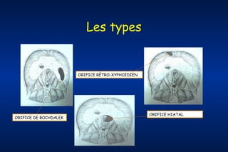 Les types

ORIFICE RÉTRO-XYPHOIDIEN

ORIFICE DE BOCHDALEK

ORIFICE HIATAL

 