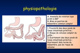 physiopathologie
A. Anomalie de rotation type
arrêt à 180°
B. Mise en position de
mésentère commun complet
1. Proximité des deux pieds de
l’anse intestinale primitive ;
2. Risque de volvulus complet du
grêle ;
3. Ecartement des deux pieds de
l’anse intestinale primitive :
écartement dela racine du
mésentère, pas de risque de
volvulus

 