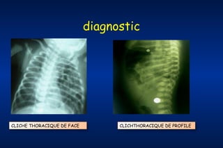 diagnostic

CLICHE THORACIQUE DE FACE

CLICHTHORACIQUE DE PROFILE

 