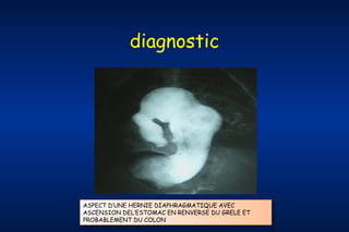 diagnostic

ASPECT D’UNE HERNIE DIAPHRAGMATIQUE AVEC
ASCENSION DEL’ESTOMAC EN RENVERSE DU GRELE ET
PROBABLEMENT DU COLON

 