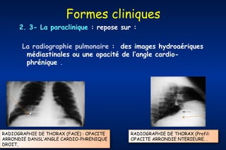 Formes cliniques
2. 3- La paraclinique : repose sur :
La radiographie pulmonaire : des images hydroaériques
médiastinales ou une opacité de l’angle cardiophrénique .

RADIOGRAPHIE DE THORAX (FACE) : OPACITE
ARRONDIE DANSL’ANGLE CARDIO-PHRENIQUE
DROIT,

RADIOGRAPHIE DE THORAX (Profil:
OPACITE ARRONDIE NTERIEURE. .

 