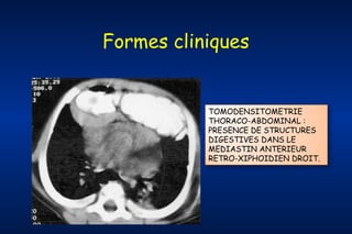 Formes cliniques

TOMODENSITOMETRIE
THORACO-ABDOMINAL :
PRESENCE DE STRUCTURES
DIGESTIVES DANS LE
MEDIASTIN ANTERIEUR
RETRO-XIPHOIDIEN DROIT.

 
