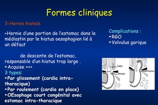 Formes cliniques
3-Hernie hiatale
►Hernie

d’une portion de l’estomac dans le
médiastin par le hiatus oesophagien lié à
un défaut
de descente de l’estomac,
responsable d’un hiatus trop large .
►Acquise +++
3 types:
►Par glissement (cardia intrathoracique)
►Par roulement (cardia en place)
►OEsophage court congénital avec
estomac intra-thoracique

Complications :
►RGO
►Volvulus garique

 