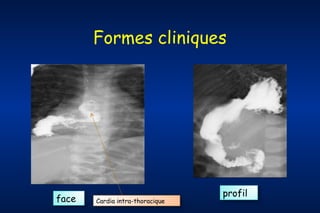 Formes cliniques

face

Cardia intra-thoracique

profil

 