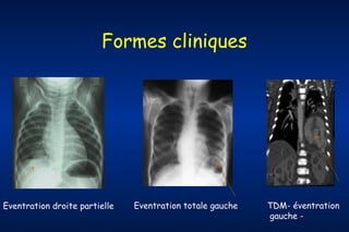 Formes cliniques

Eventration droite partielle

Eventration totale gauche

TDM- éventration
gauche -

 