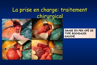 La prise en charge: traitement
chirurgical
IMAGE EN PER-OPÉ DE
TYPE BOCHDALEK
GAUCHE

 