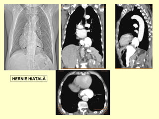 HERNIE HIATALĂ
 