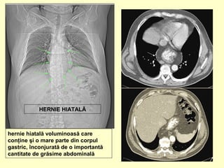 HERNIE HIATALĂ
hernie hiatală voluminoasă care
conţine şi o mare parte din corpul
gastric, înconjurată de o importantă
cantitate de grăsime abdominală
 