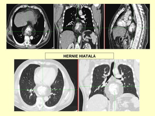 HERNIE HIATALĂ
 