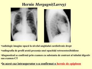 •radiologic imagine opacă la nivelul unghiului cardiofrenic drept
•radiografia de profil arată prezenţa unei opacităţi retrocostoxifoidiene
•diagnosticul se confirmă prin examen cu substanta de contrast al tubului digestiv
sau examen CT
•în acest caz intraoperator s-a confirmat o hernie de epiploon
Hernie Morgagni(Larrey)
 