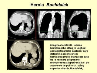 imaginea localizată la baza
hemitoracelui stâng în unghiul
costodiafragmatic posterior care
determina ascensiunea;
hemidiafragmului stâng este data
de o herniere de grăsime;
retroperitoneală (perirenală) şi de
asemenea de pol renal stâng
superior –hernie Bochdalek;
Hernia Bochdalek
 