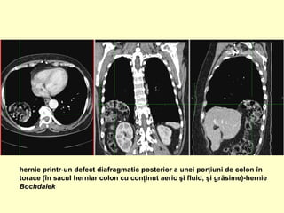 hernie printr-un defect diafragmatic posterior a unei porţiuni de colon în
torace (în sacul herniar colon cu conţinut aeric şi fluid, şi grăsime)-hernie
Bochdalek
 