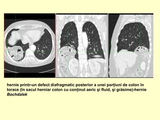 hernie printr-un defect diafragmatic posterior a unei porţiuni de colon în
torace (în sacul herniar colon cu conţinut aeric şi fluid, şi grăsime)-hernie
Bochdalek
 