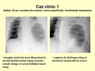 • imagine aerică de mari dimensiuni la
nivelul hemitoracelui stang; fracturi
costale stângi, revarsat lichidian bazal
stang
• ruptura de diafragm stâng şi
hernierea stomacului în torace
Caz clinic 1
bărbat ,45 ani, accident de masină, coma superficială, insuficienţă respiratorie
 