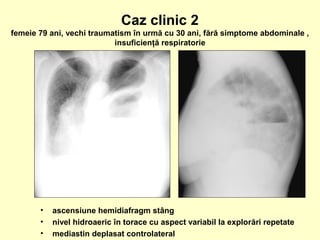 • ascensiune hemidiafragm stâng
• nivel hidroaeric în torace cu aspect variabil la explorări repetate
• mediastin deplasat controlateral
Caz clinic 2
femeie 79 ani, vechi traumatism în urmă cu 30 ani, fără simptome abdominale ,
insuficienţă respiratorie
 