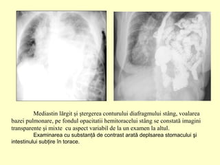 Mediastin lărgit şi ştergerea conturului diafragmului stâng, voalarea
bazei pulmonare, pe fondul opacitatii hemitoracelui stâng se constată imagini
transparente şi mixte cu aspect variabil de la un examen la altul.
Examinarea cu substanţă de contrast arată deplsarea stomacului şi
intestinului subţire în torace.
 