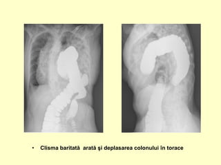 • Clisma baritată arată şi deplasarea colonului în torace
 