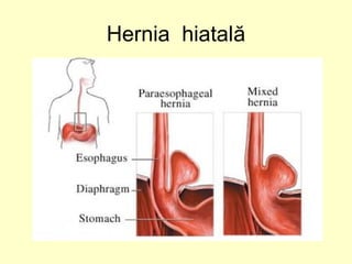 Hernia hiatală
 