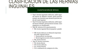 CLASIFICACION DE LAS HERNIAS
INGUINALES
CLASIFICACION DE NYHUS
 