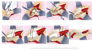 Hernias de la Pared abdominal, Ed. Alfil 2009; Tecnica de Shuoldice, Benavid, Robert; Cap 38, Pg 303-312
 