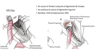 Mcvay Incision Hernioplastía Inguinal.pptx
