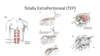 Totally ExtraPeritoneal (TEP)
Zollinger's Atlas of Surgical Operations, Editorial McGraw Hill, Repair of inguinal
herna Laparoscopic, Cap 113
 