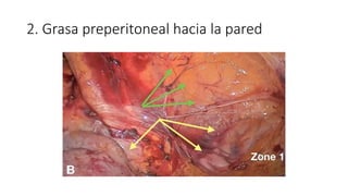 2. Grasa preperitoneal hacia la pared
 