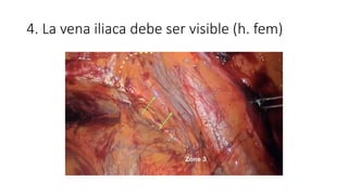 4. La vena iliaca debe ser visible (h. fem)
 