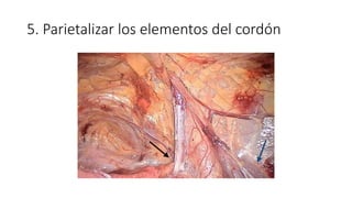 5. Parietalizar los elementos del cordón
 