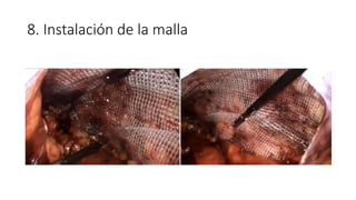 8. Instalación de la malla
 