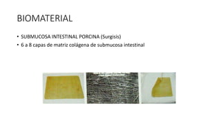 BIOMATERIAL
• SUBMUCOSA INTESTINAL PORCINA (Surgisis)
• 6 a 8 capas de matriz colágena de submucosa intestinal
 