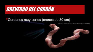 BREVEDAD DEL CORDÓN:
•Cordones muy cortos (menos de 30 cm)
 
