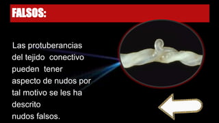 FALSOS:
Las protuberancias
del tejido conectivo
pueden tener
aspecto de nudos por
tal motivo se les ha
descrito
nudos falsos.
 