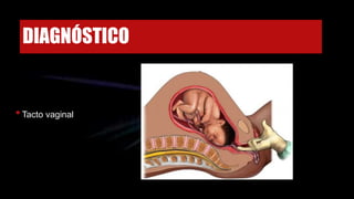 DIAGNÓSTICO
•Tacto vaginal
 
