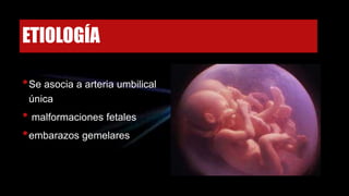 ETIOLOGÍA
•Se asocia a arteria umbilical
única
• malformaciones fetales
•embarazos gemelares
 